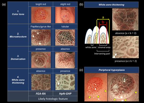 Spectrum of gastric neoplasms in Helicobacter pylori-naïve patients