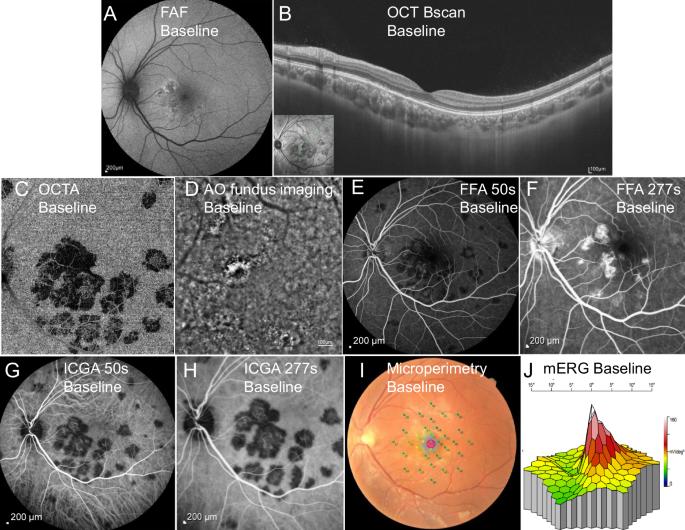 Immune pathogenic response landscape of acute posterior multifocal placoid pigment epitheliopathy revealed by scRNA sequencing