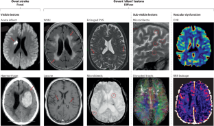 Endothelial cells as key players in cerebral small vessel disease