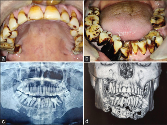 Langerhans Cell Histiocytosis Involving the Maxilla and Mandible - A Case Report.