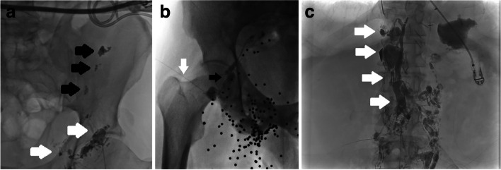Lymphatic leaks - success of intranodal lymphangiogram first strategy.