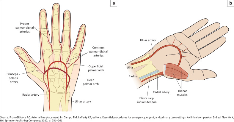 A guide for arterial line insertion for the South African primary care practitioner.