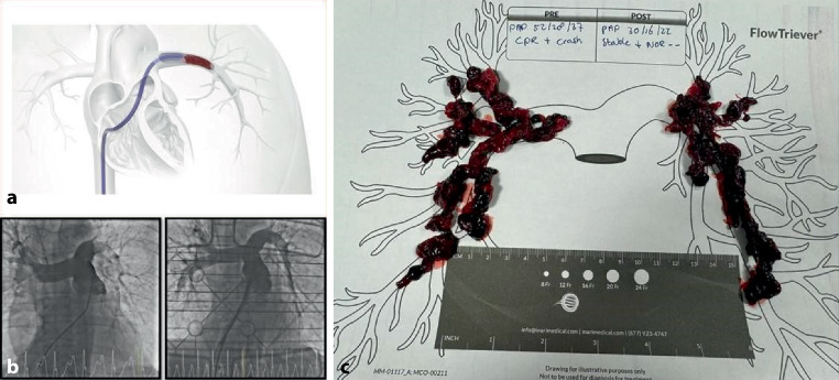 Catheter-directed therapy with the FlowTriever system for intermediate-high and high-risk pulmonary embolism: a single-centre experience.