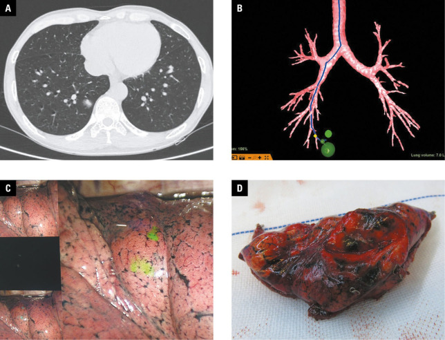 Preoperative localization of pulmonary nodules: virtual bronchoscopic navigation vs a 4‑hook localization needle.