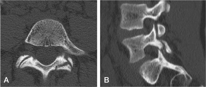 An Acta Orthopaedica educational article: Treatment of pediatric spondylolysis and spondylolisthesis.