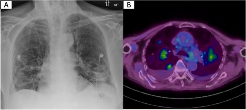 A unique case of extranodal marginal zone lymphoma with synchronous pulmonary and dermatologic manifestations