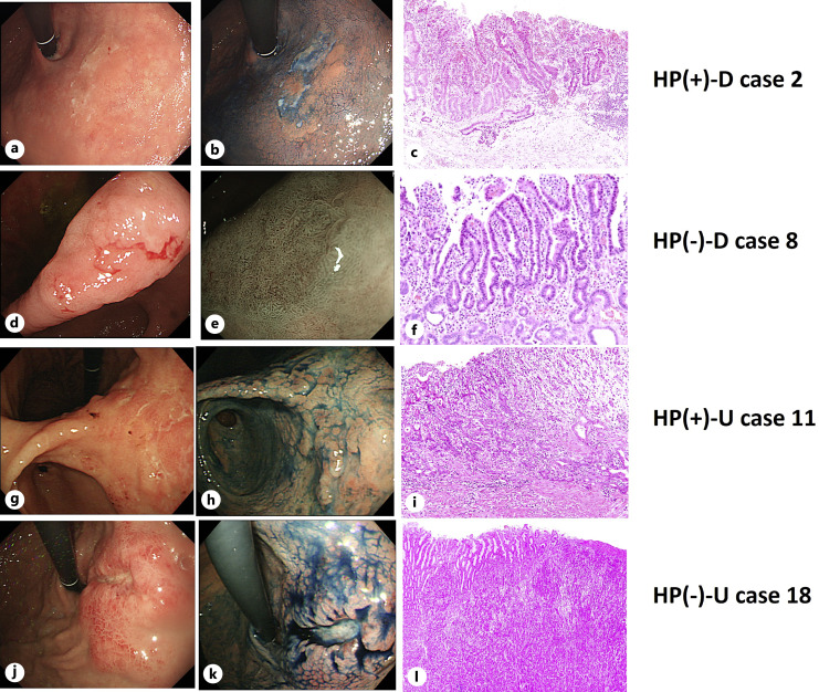 Comparison of Genetic Mutations of Gastric Cancer Diagnosed before or after Helicobacter pylori Eradication and between Differentiated and Undifferentiated Types Using Next-Generation Sequencing.