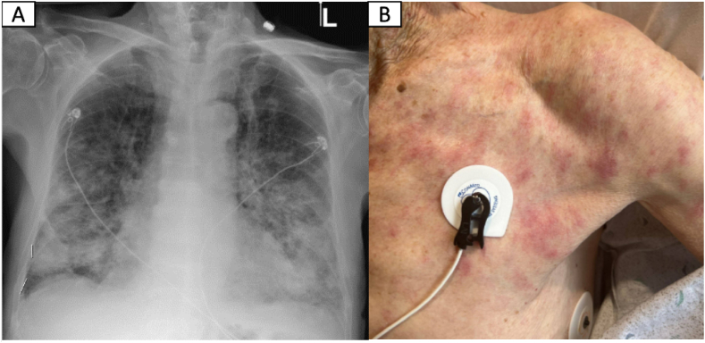 A unique case of extranodal marginal zone lymphoma with synchronous pulmonary and dermatologic manifestations