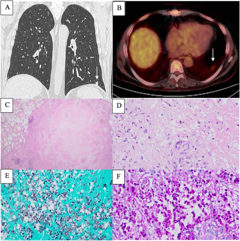 Spiculated Nodule in a Lung Transplant Recipient: Localized Cryptococcosis