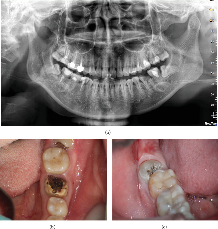 Autotransplantation of a Third Molar to Replace Compromised Molar With the Individual Three-Dimensional Printed Ultrasonic Osteotome: A Case Report.
