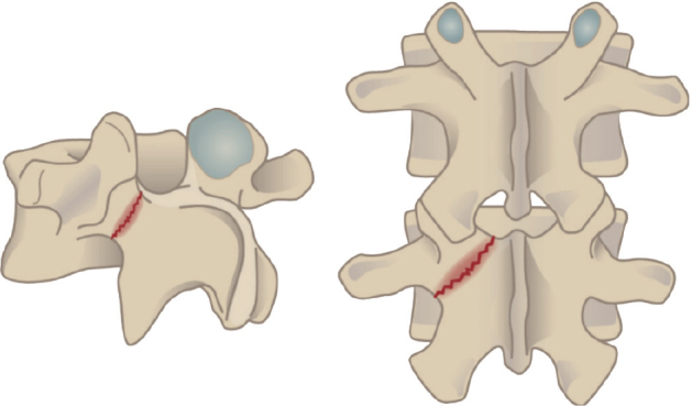An Acta Orthopaedica educational article: Treatment of pediatric spondylolysis and spondylolisthesis.