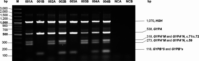 Multiplex-PCR technique to predict polymorphic antigens - M, N, S and s - and associations between their alleles and Mi<sup>a</sup>-associated hybrid glycophorins.