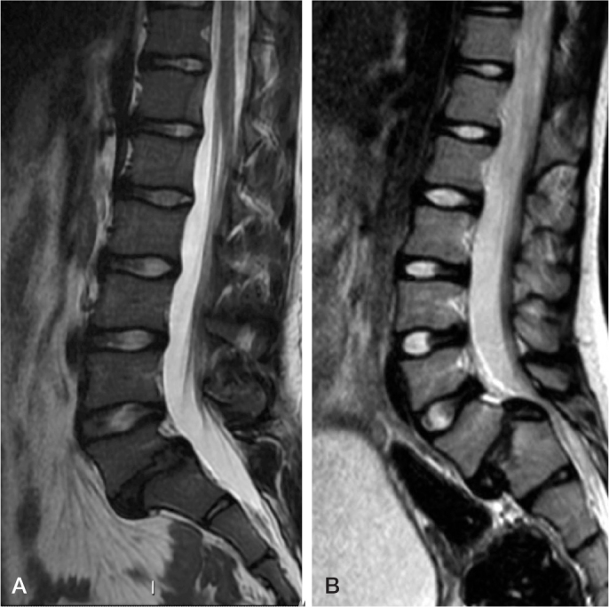 An Acta Orthopaedica educational article: Treatment of pediatric spondylolysis and spondylolisthesis.