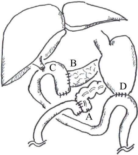 En bloc Right Hemicolectomy with Pancreaticoduodenectomy for Advanced Ascending Colon Cancer.