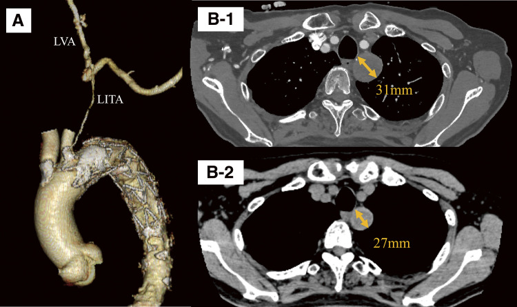Successful Hybrid Endovascular and Open Approach for Exclusion of a Left Subclavian Artery Aneurysm.