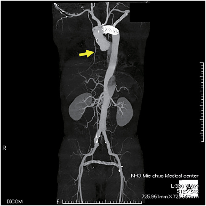 Double-Pedicled Vertical Rectus Abdominis Myocutaneous Flap for Sternal Dehiscence Due to Deep Sternal Wound Infection: The Twelfth Intercostal Artery Perforator as an Additional Pedicle.