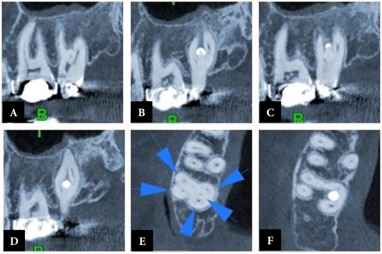 Maxillary Second Molar with Five Root Canals and a Root-Like Enamel Pearl: A Rare Case Report.