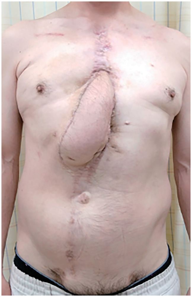 Double-Pedicled Vertical Rectus Abdominis Myocutaneous Flap for Sternal Dehiscence Due to Deep Sternal Wound Infection: The Twelfth Intercostal Artery Perforator as an Additional Pedicle.