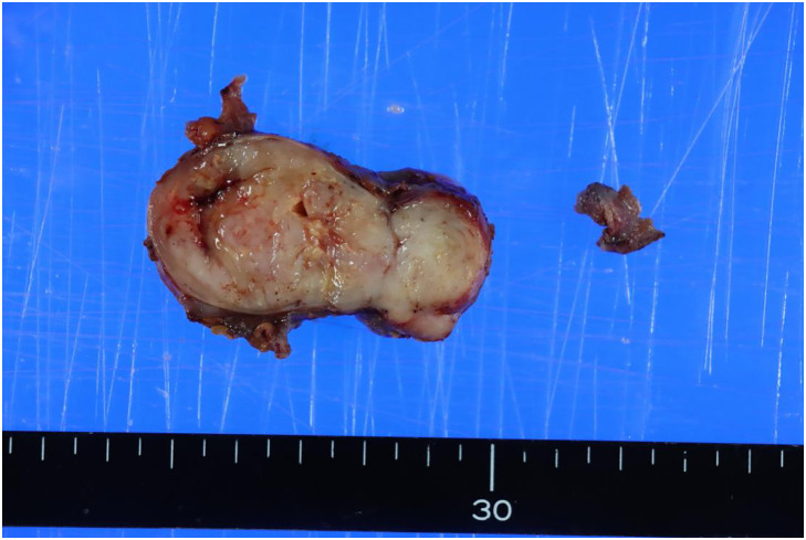 A Case of Myoepithelioma-Like Tumor of the Vulvar Region after Removal of an Inguinal Tumor.
