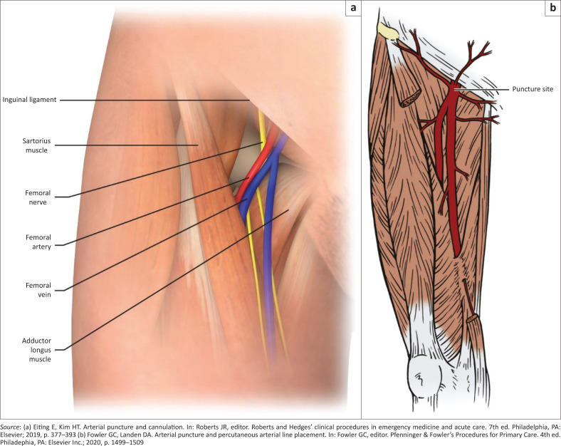A guide for arterial line insertion for the South African primary care practitioner.