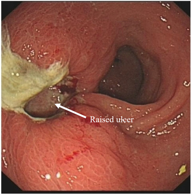 A Rare Case of Post-Transplant Lymphoproliferative Disorder Presenting as Hodgkin Lymphoma After Autologous Hematopoietic Stem Cell Transplantation: A Case Report and Literature Review.