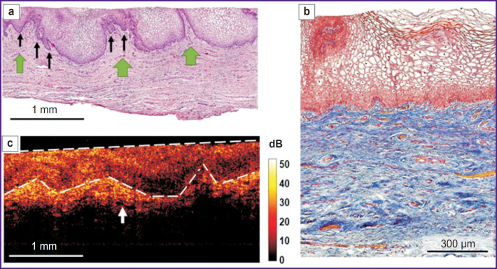 Criteria for Vaginal Atrophic Changes in Genitourinary Syndrome of Menopause Using Optical Coherence Tomography.