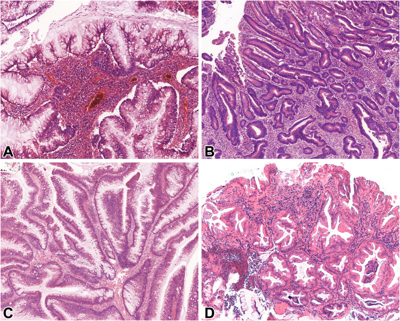 Examination of non-conventional dysplasias adjacent to colorectal adenocarcinoma in patients with IBD.