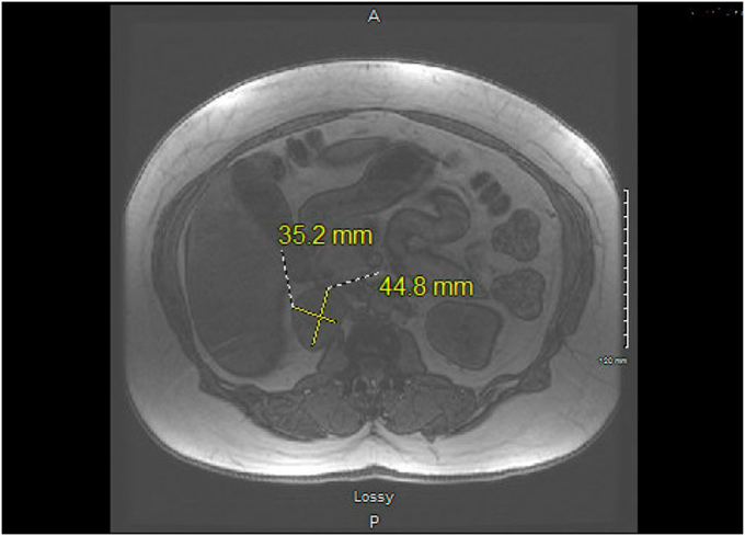 Two Cases of Composite Pheochromocytoma-Ganglioneuromas With Plasma Metanephrine Levels in the Subclinical Range Pheochromocytoma-Ganglioneuroma