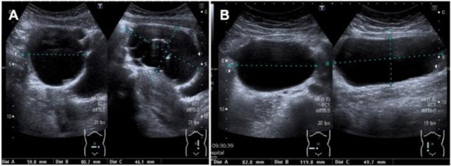 Management of Recurrent Large Bilateral Benign Mucinous Cystadenomas of the Ovary: A Case Report.