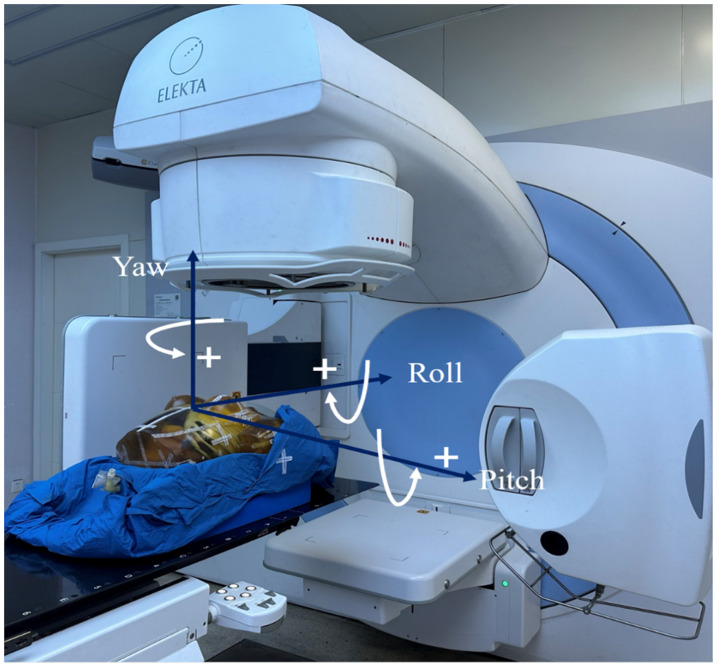 Effect of the Residual Errors on the Dose for Left-Sided Breast Cancer Radiotherapy After Translation Error Correction Based on CBCT.
