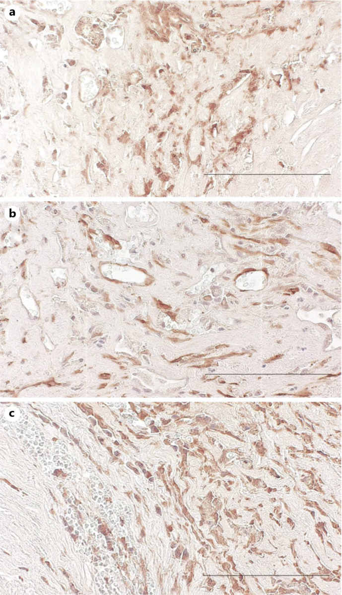 Evaluation of Metabolism-Associated Proteins in Abdominal Aortic Aneurysm.