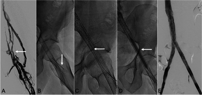 Direct percutaneous puncture of occluded venous stents as an adjunctive technique to restore patency.