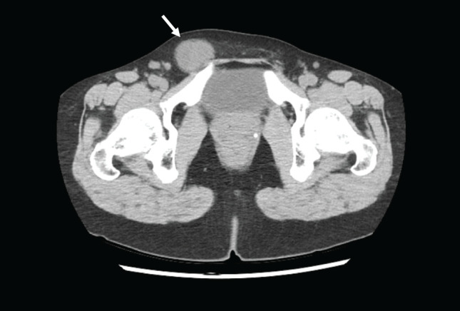 A Case of Myoepithelioma-Like Tumor of the Vulvar Region after Removal of an Inguinal Tumor.