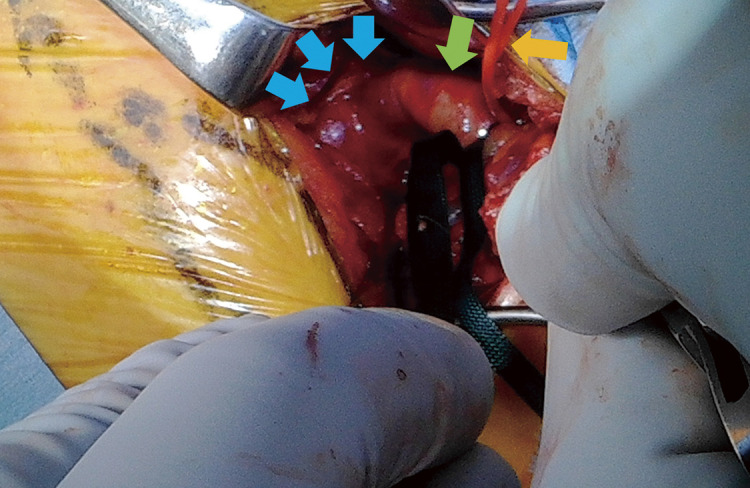 Successful Hybrid Endovascular and Open Approach for Exclusion of a Left Subclavian Artery Aneurysm.