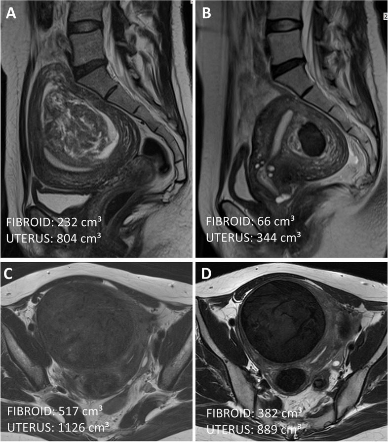 Postoperative symptom changes following uterine artery embolization for uterine fibroid based on FIGO classification.
