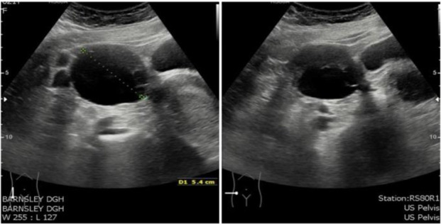 Management of Recurrent Large Bilateral Benign Mucinous Cystadenomas of the Ovary: A Case Report.