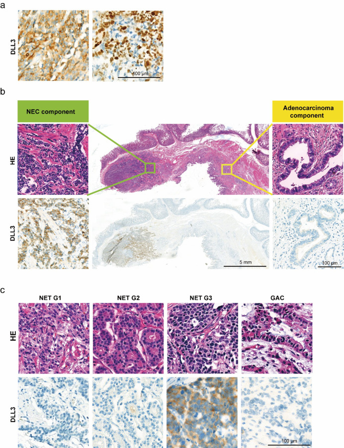 Exploring the expression of DLL3 in gastroenteropancreatic neuroendocrine neoplasms and its potential diagnostic value.