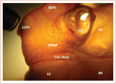 Catheter Ablation for Vasovagal Syncope: The Therapeutic Potential of Gateway Plexi.