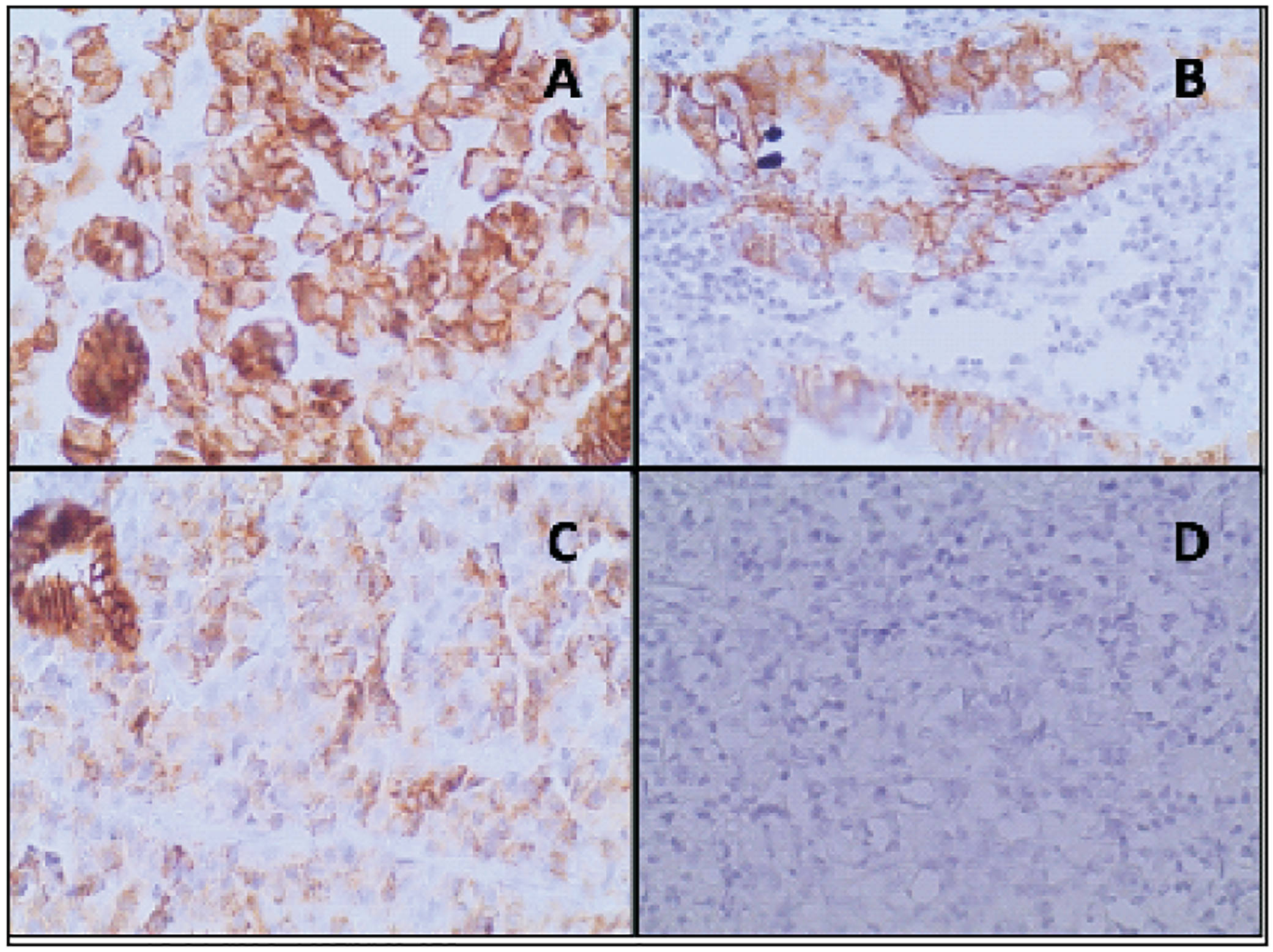 Analysis of the loss of Epithelial Cadherin expression in gastric cancer in Zambia.
