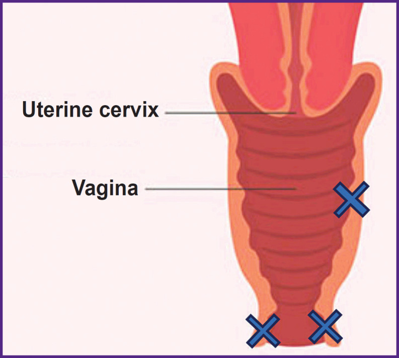 Criteria for Vaginal Atrophic Changes in Genitourinary Syndrome of Menopause Using Optical Coherence Tomography.