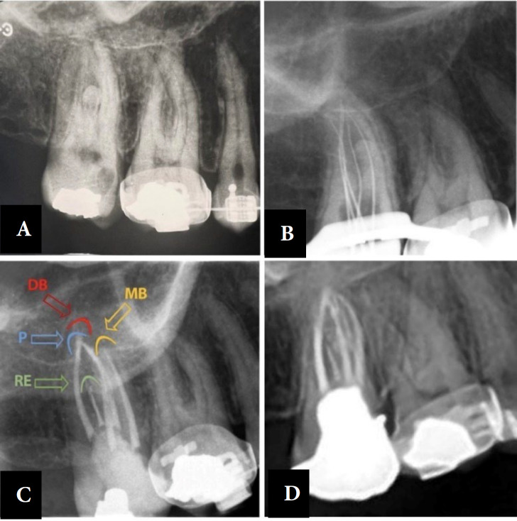Maxillary Second Molar with Five Root Canals and a Root-Like Enamel Pearl: A Rare Case Report.