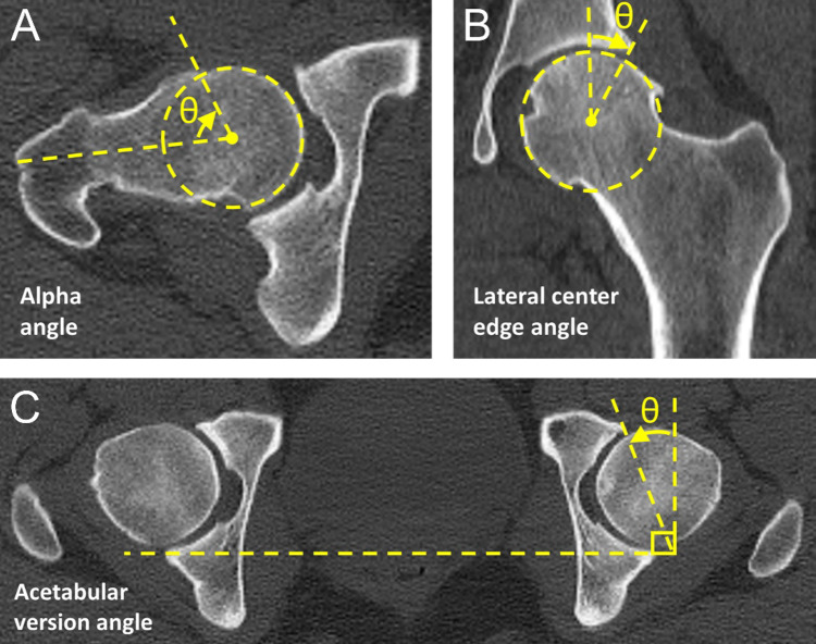 Asymptomatic female softball pitchers have altered hip morphology and cartilage composition.