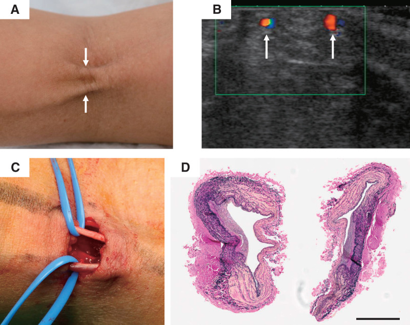 A Case of Elbow Extension Limitation Caused by Phlebosclerosis Following Peripheral Intravenous Chemotherapy: A Case Report and Literature Review.