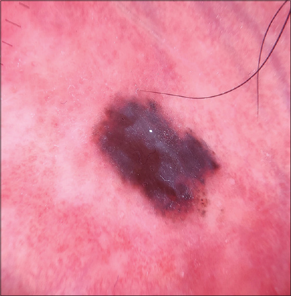 Kissing nevus or divided nevus of the uncircumcised penis in an Indian man.