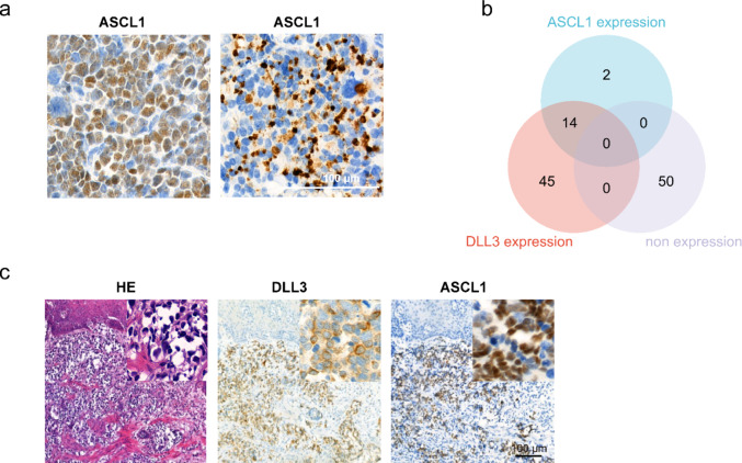 Exploring the expression of DLL3 in gastroenteropancreatic neuroendocrine neoplasms and its potential diagnostic value.