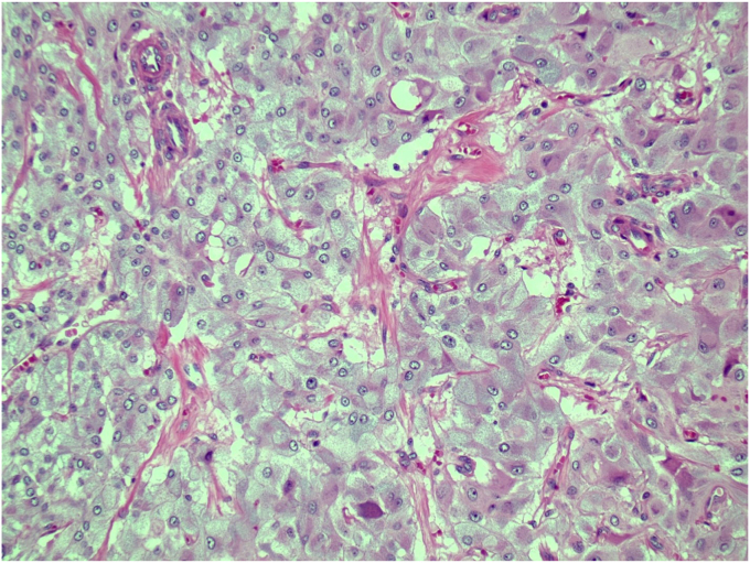 Two Cases of Composite Pheochromocytoma-Ganglioneuromas With Plasma Metanephrine Levels in the Subclinical Range Pheochromocytoma-Ganglioneuroma