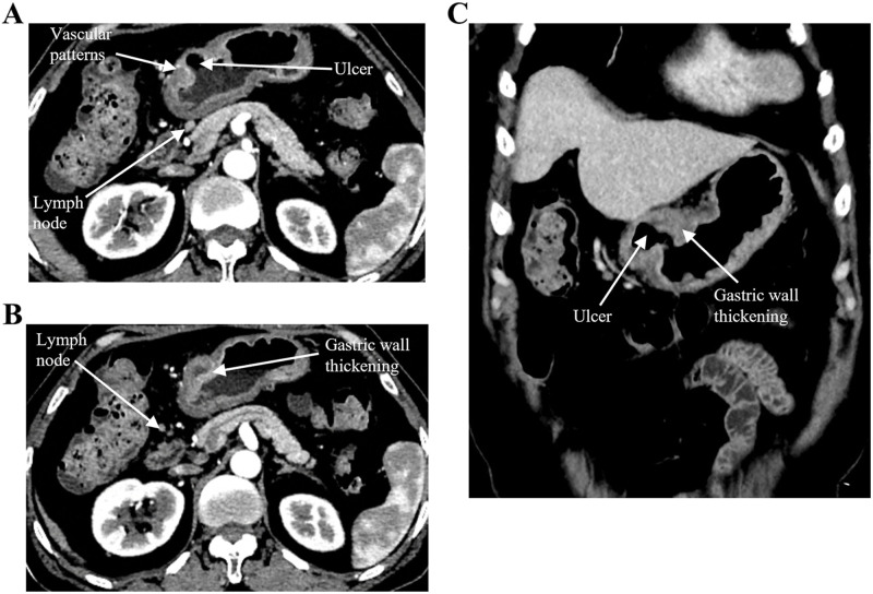 A Rare Case of Post-Transplant Lymphoproliferative Disorder Presenting as Hodgkin Lymphoma After Autologous Hematopoietic Stem Cell Transplantation: A Case Report and Literature Review.