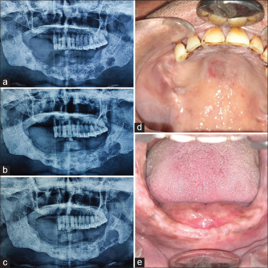 Langerhans Cell Histiocytosis Involving the Maxilla and Mandible - A Case Report.