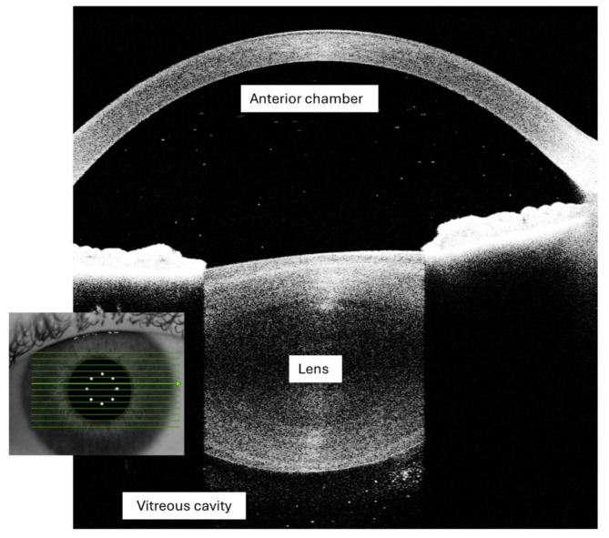 Reducing the risk of visual disability for children with juvenile idiopathic arthritis uveitis through disease surveillance: past and future challenges.