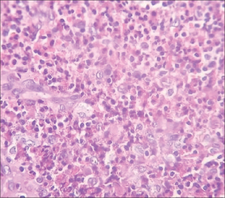 Langerhans Cell Histiocytosis Involving the Maxilla and Mandible - A Case Report.